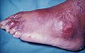 Tophus of the toe, and over the external malleolus