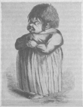 Woman with cretinism. Illustration in Rudolf Virchow, 1856.
