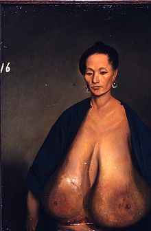 İnsan göğsünde hipertrofi, 1848/49 tarihli resim