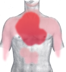 El dolor que siente la gente está en las zonas indicadas en rojo: Muchas personas indican las zonas en rojo oscuro; las que aparecen en rojo claro son más raramente preocupantes. Esta imagen muestra el pecho de frente.