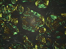 Amyloidosis - Lymph nodes in polarized light