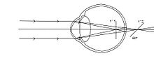 Astigmatism B