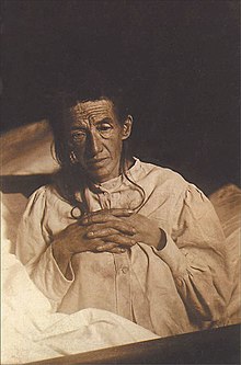 Auguste, o paciente Alois Alzheimer costumava descrever o mal de Alzheimer, em 1901. O mal de Alzheimer é comumente associado à demência.