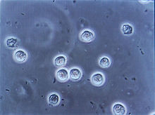Molti bacilli (batteri a forma di bastoncello, qui mostrati come neri e a forma di fagiolo) sono mostrati tra i globuli bianchi, come si vede guardando l'urina attraverso un microsopo. Questi cambiamenti mostrano un'infezione del tratto urinario.