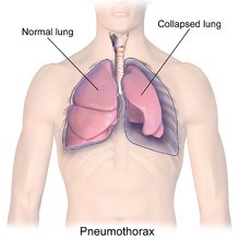 Illustration eines Pneumothorax ("kollabierte Lunge")