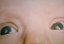 Tällä vauvalla oli syntyessään vihurirokon aiheuttama harmaakaihi (sameat valkoiset silmälinssit).  