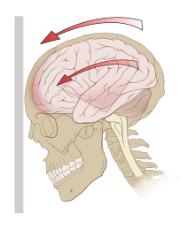 Una lesión cerebral traumática puede ocurrir cuando una persona se golpea la cabeza