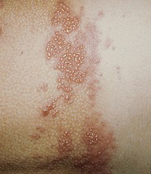 Shingles (Herpes Zoster)