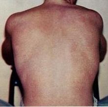 The typical rash of dengue fever