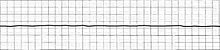 ECG derivation of an asystole