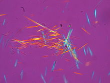 Tiges dopées de cristaux d'acide urique (MSU) provenant d'un échantillon de liquide synovial photographié au microscope en lumière polarisée.