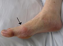 Goutte se présentant dans l'articulation à la base du plus gros orteil. Notez la légère rougeur de la peau sur l'articulation.