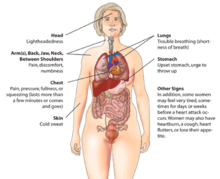Ataque al corazón ( infarto de miocardio) Signos de advertencia en las mujeres.  