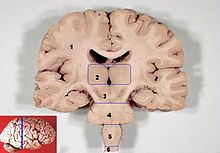 Frontal section of a human brain. Area /5/ - Medulla oblongata