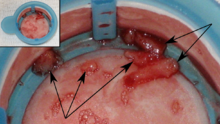 Thrombi removed from the coronary arteries