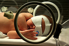 Neugeborenes Baby wird wegen Gelbsucht behandelt