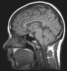 Az emberi fej MRI-vizsgálatának képe.