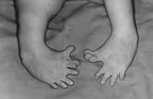 Baby geboren uit een moeder die thalidomide nam tijdens de zwangerschap  