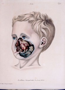 Noma - coloured lithograph after a drawing by Robert Froriep (1836)