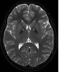 Järndepåer i globus pallidus, avbildning med MRT  