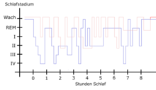 In the case of restless legs syndrome (shown in red), constant nocturnal movements mean that, compared to healthy sleep (shown in blue), the deep sleep stages III and IV are not reached, or are reached only very rarely, and those affected wake up significantly more often.