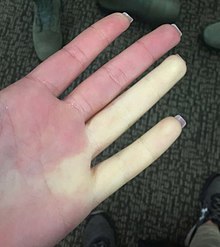 Raynaud care afectează două degete la femei