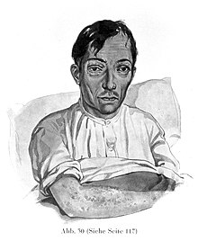 Disegno di un paziente con lo scorbuto, Karl Heinrich Baumgaertner, 1929