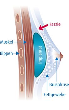 In subfascial implantation, the implant is inserted under the fascia.