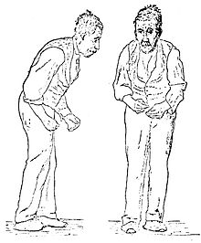 Croquis de Parkinson de Sir William Richard Gowers.
