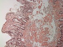 Amyloidosis