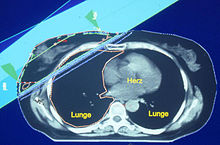 Radiation plan for a breast cancer