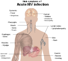 Síntomas de la infección aguda por el VIH  