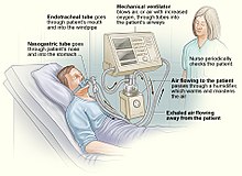 Un diagrama sobre el funcionamiento de un ventilador de presión positiva.  
