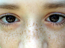 Freckles on the face