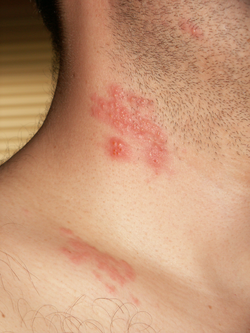 Herpes zoster potilaan kaulalla