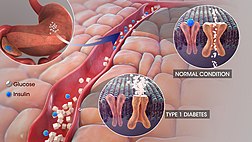 Medizinische 3D-Animation noch von Typ-1-Diabetes, die die Insulinproduktion bei einem Diabetiker und in normalem Zustand zeigt.