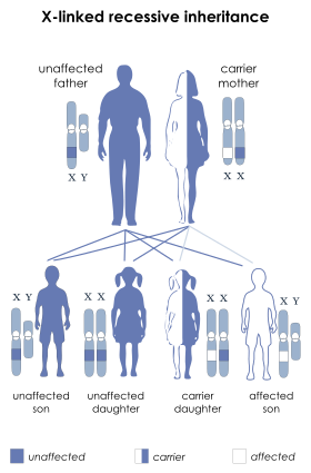 L'hémophilie est transmise sous forme d'allèle dans le chromosome X