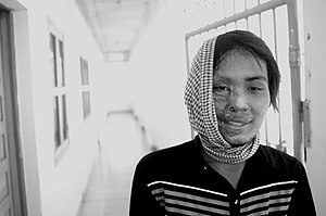 Victime d'un jet d'acide, Cambodge
