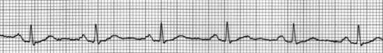 EKG "Ritmo juosta" - kiekvienas QRS yra vienas širdies ritmas