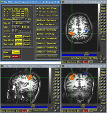 Cognitieve Remediatietherapie (CRT) is een 'evidence-based' therapie die helpt bij het verbeteren van de cognitieve tekorten die vaak voorkomen bij schizofrenie. De effecten van CRT kunnen worden gezien op fMRI-scans van de hersenen.  