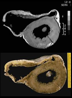 MRI image and pathological preparation of an ARVCM
