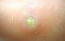 Blood vessels as dark spots after callus ablation