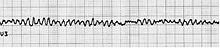 Cardiopulmonary resuscitation