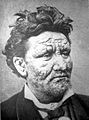 24-year-old man from Norway, suffering from leprosy, 19th century.