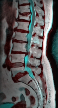Obraz MRI ludzkiego kręgosłupa. Część w kolorze niebieskim to kanał kręgowy. Widać również, że jeden kręg został złamany (L-3), co oznacza, że rdzeń kręgowy jest uciśnięty w jednym punkcie (L-3,L-4 impingement) .