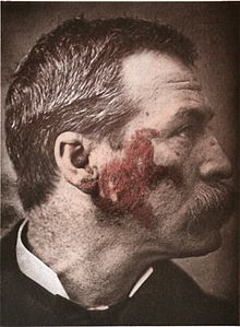 Ein handkoloriertes Foto von 1886, das Lupus zeigt (die roten Teile auf dem Foto)