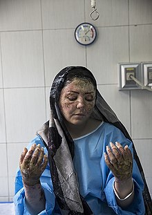 Victima unui atac cu acid este tratată la spital, în Teheran, 2018.