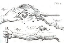 Schematic representation of the "Starstich" (1764)